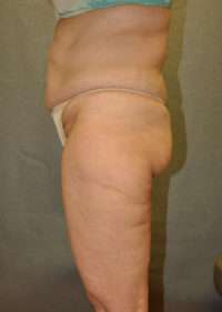 Abdominoplasty