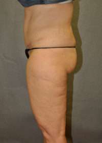 Abdominoplasty