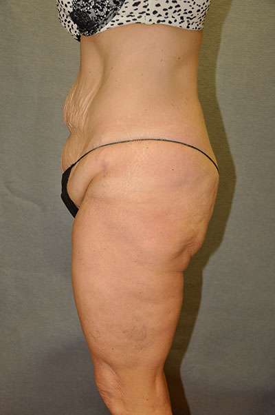 Abdominoplasty