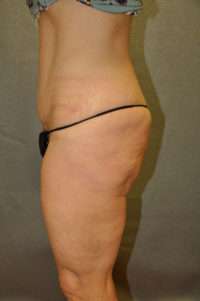 Abdominoplasty