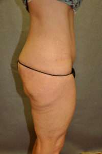 Abdominoplasty