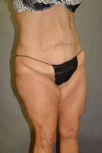 Abdominoplasty