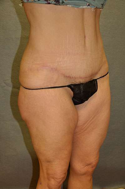 Abdominoplasty