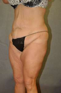 Abdominoplasty