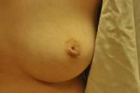 Nipple Correction