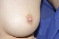 Nipple Correction