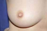 Nipple Correction