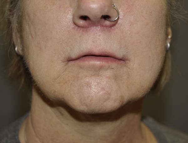 Lip Lift Case 6528 After Photo Lip Lift