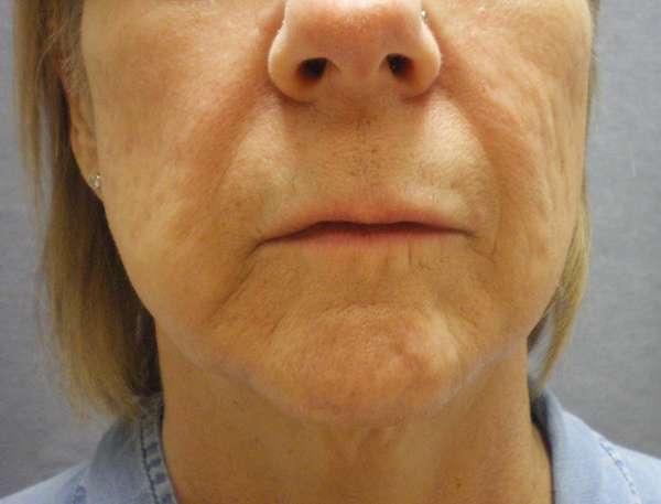 Lip Lift Case 6528 Before Photo Lip Lift