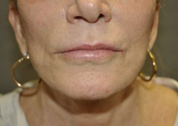 Lip Lift Case 6529 Before Photo Lip Lift