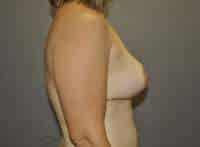 Breast Lift
