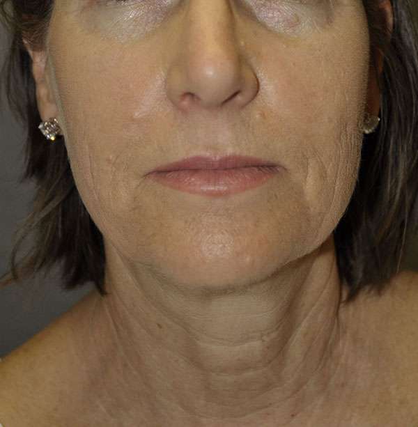 Facelift Case 6862 Before Photo Facelift