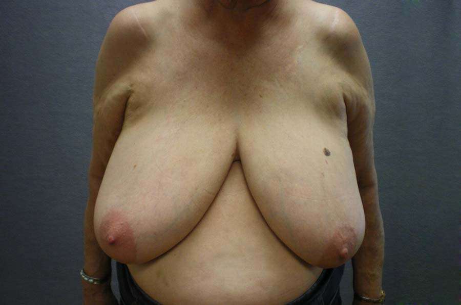 Breast Reduction Case 7194 Before Photo Breast Reduction