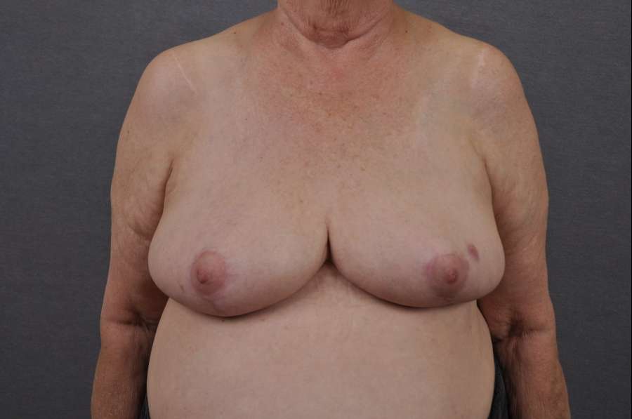 Breast Reduction Case 7194 After Photo Breast Reduction