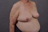 Breast Reduction