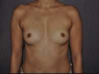 Breast Augmentation