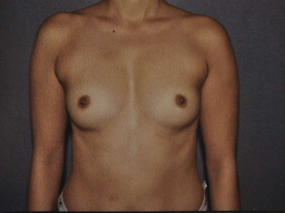 Breast Augmentation Case 9579 Before Photo Breast Augmentation