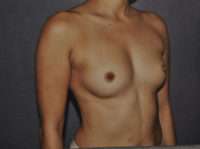 Breast Augmentation