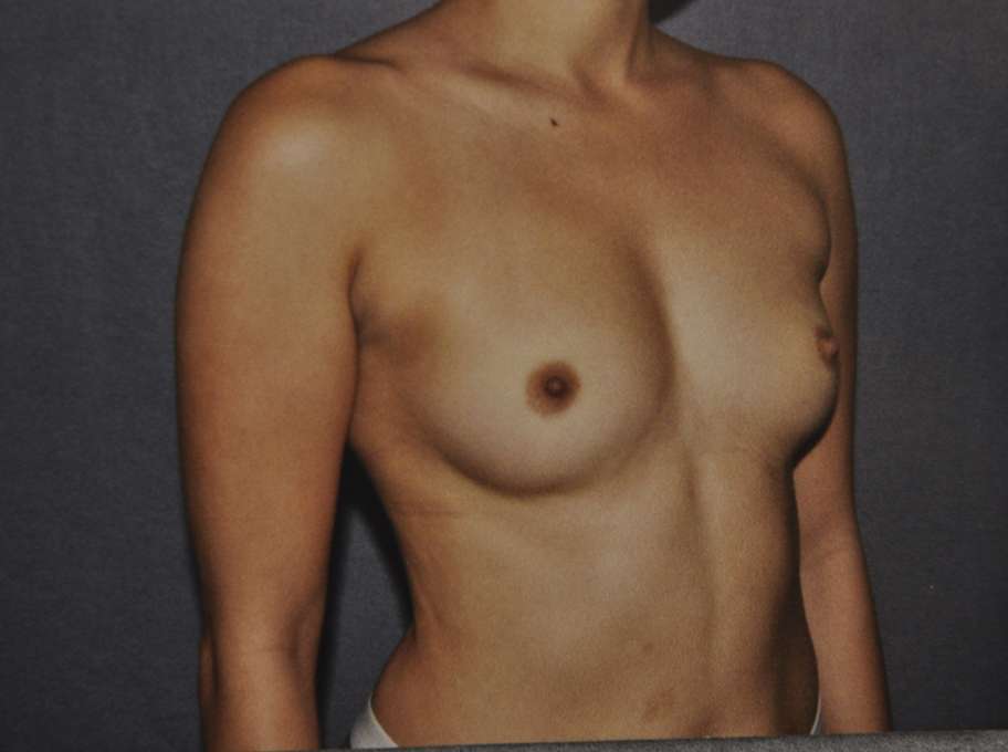 Breast Augmentation