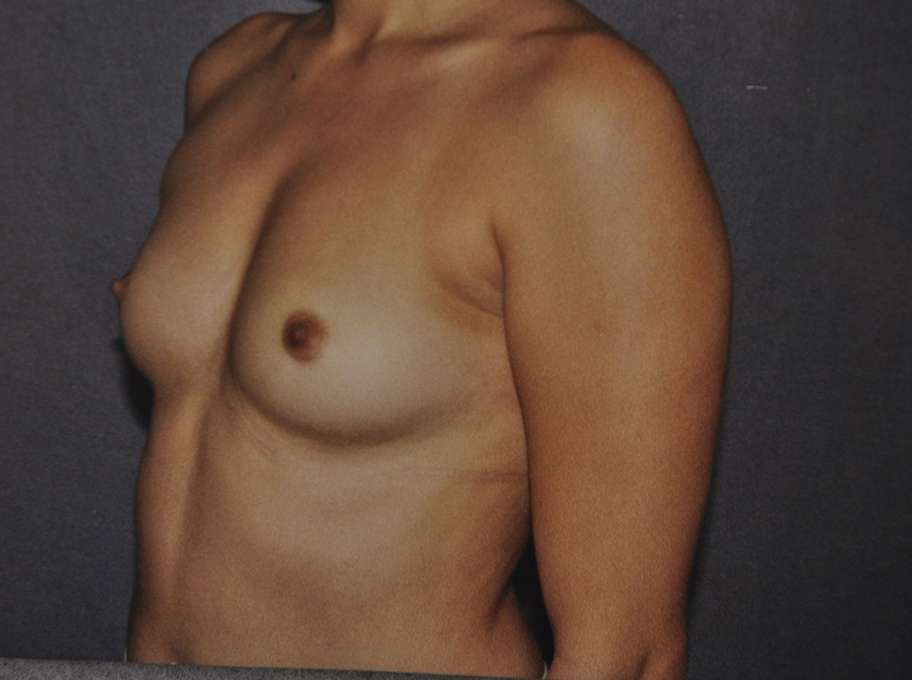 Breast Augmentation