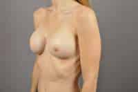 Breast Implant Removal