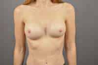 Breast Implant Removal