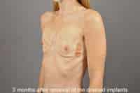 Breast Implant Removal