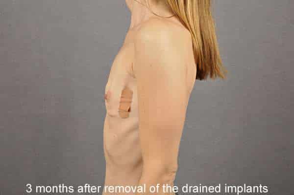 Breast Implant Removal Case 9759 After Photo Breast Implant Removal