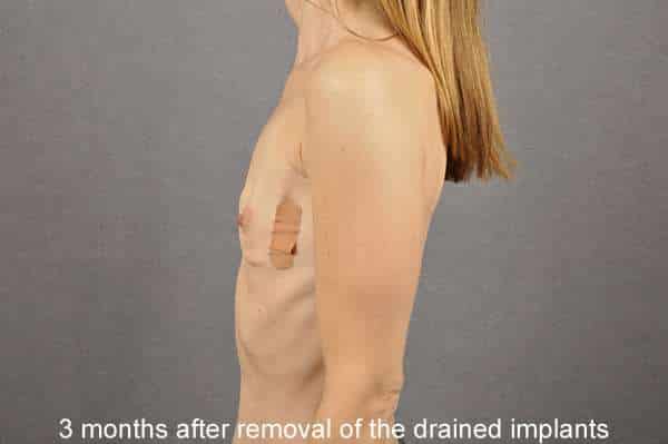 Breast Implant Removal