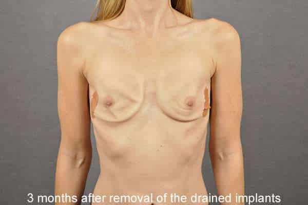 Breast Implant Removal