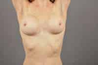 Breast Implant Removal