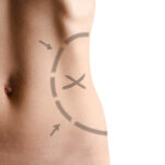lipectomy procedure for body sculpting