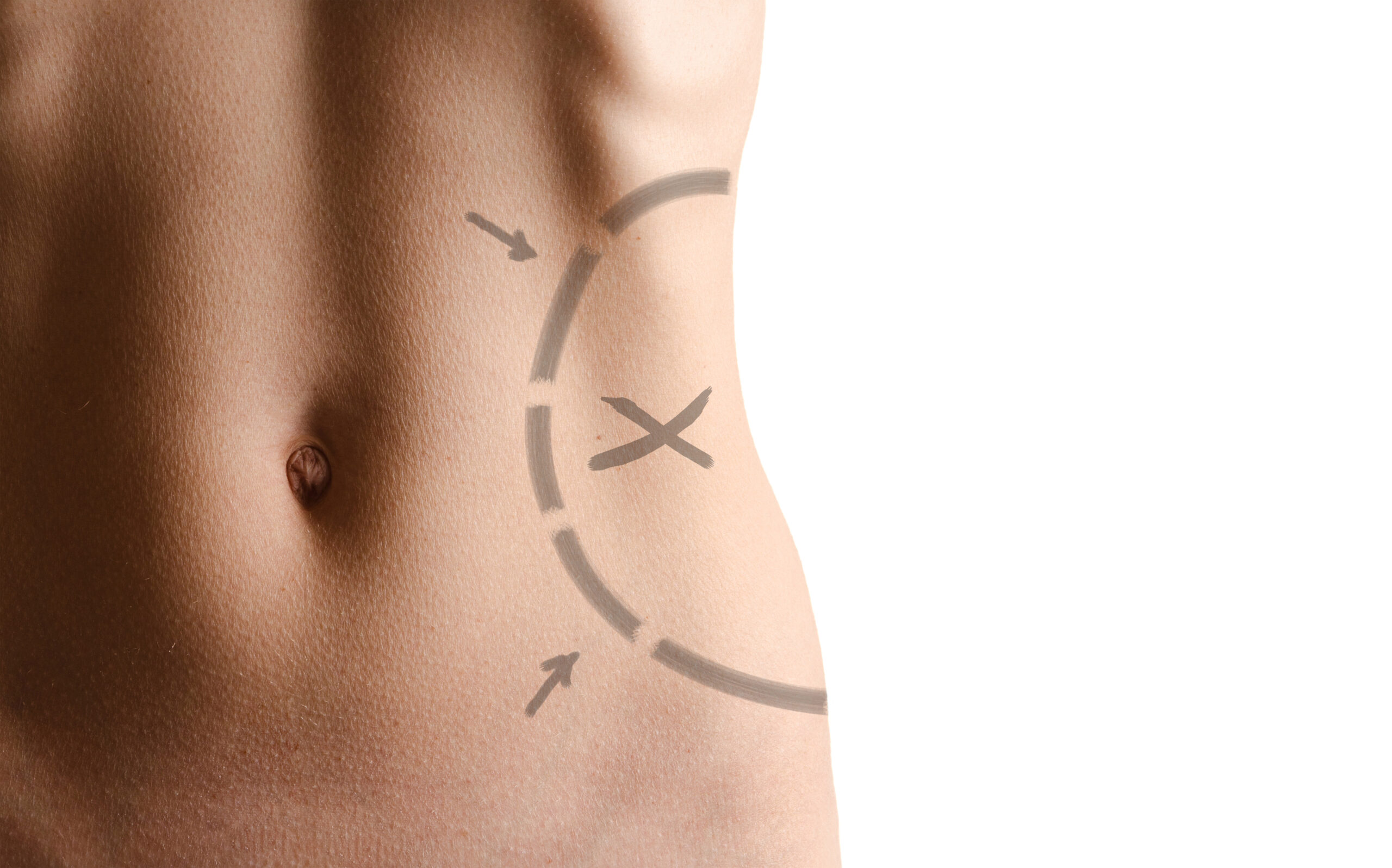 lipectomy procedure for body sculpting