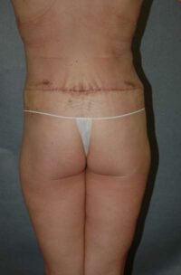 Belt Lipectomy