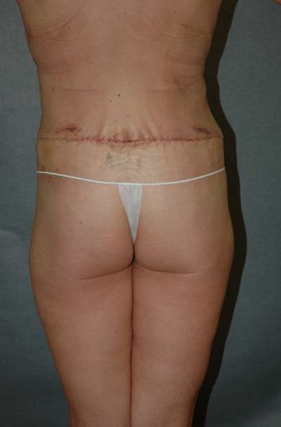 Belt Lipectomy