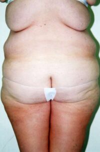 Belt Lipectomy