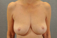 Breast Lift