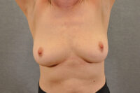 Breast Implant Removal