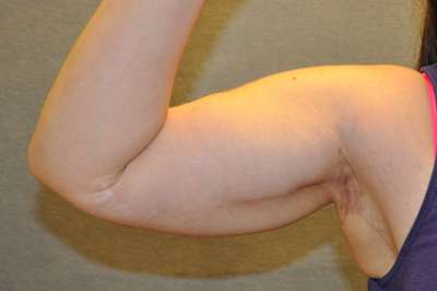 Arm Lift Case 19395 After Photo Arm Lift
