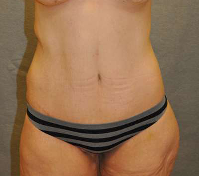 Belt Lipectomy Case 19402 After Photo Belt Lipectomy