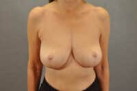 Breast Lift