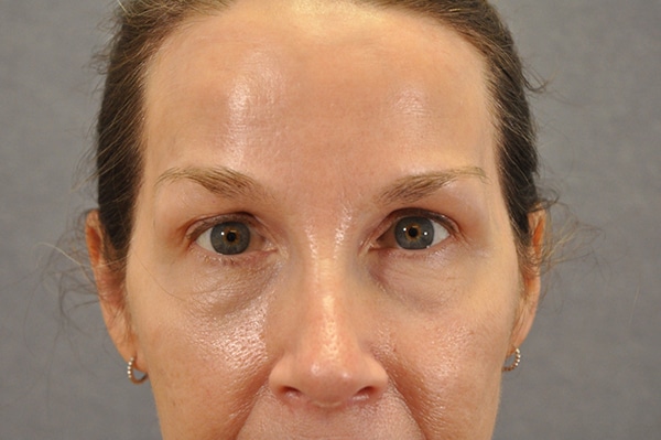 Brow lift Case 19460 After Photo Brow lift
