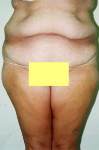 Belt Lipectomy