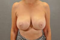 Breast Lift
