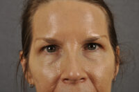 Brow lift