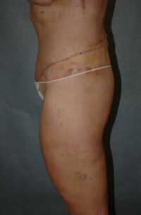 Belt Lipectomy