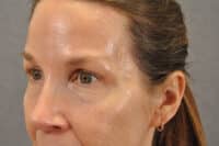 Brow lift