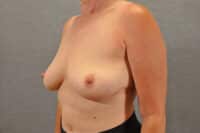 Breast Implant Removal