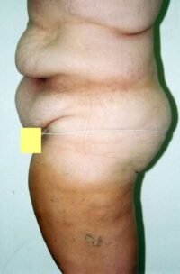 Belt Lipectomy