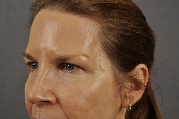 Brow lift